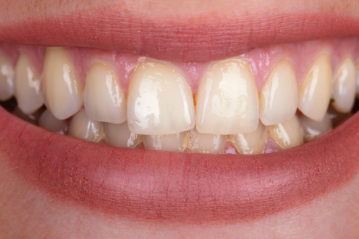Dental Treatments before