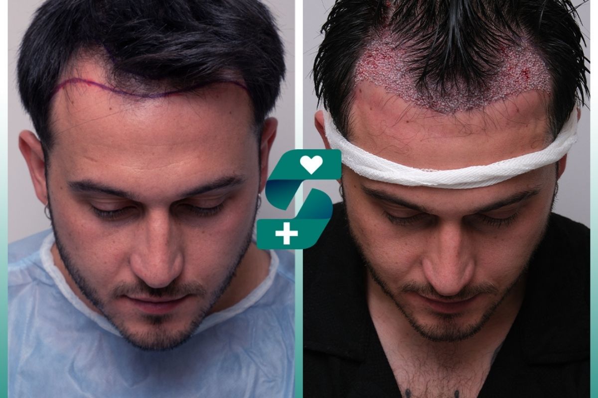 Hair Transplants Treatments Hair Transplants Treatments